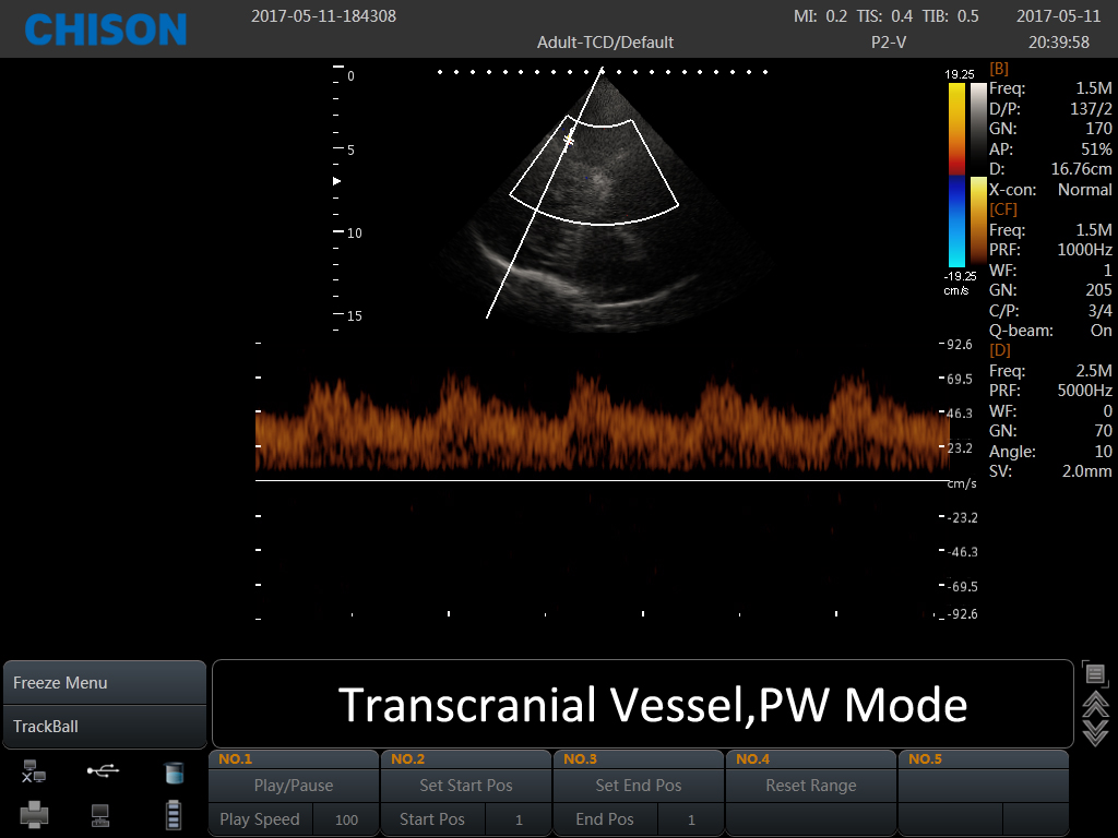 SonoBook Transcranial vessel PW